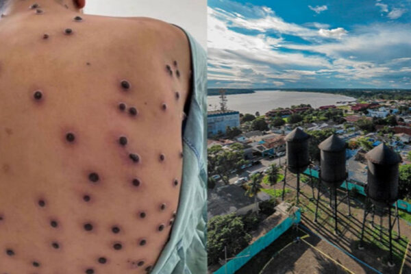 Mpox: Porto Velho registra quatro casos confirmados
