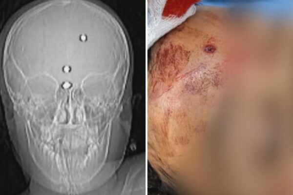 Menino baleado na cabeça acorda, volta a falar e pede para ir para casa